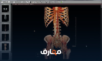 تصوير الأوعية التاجية باستخدام التصوير المقطعي CT course preview