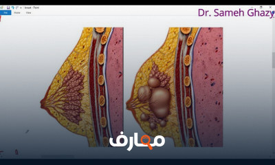 أمراض الثدي: فهم شامل لاضطرابات الثدي course preview